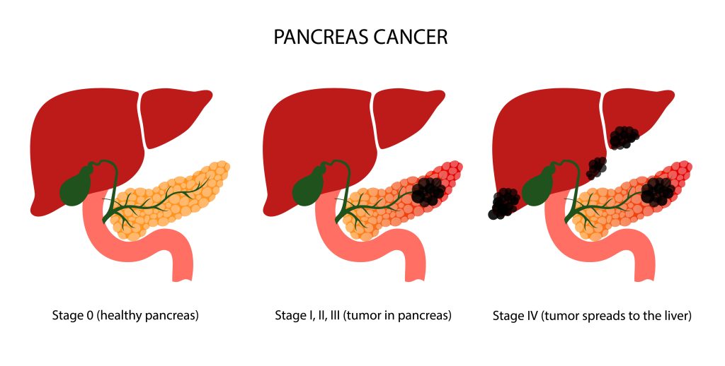 What Is Pancreatic Cancer? | National Pancreatic Cancer Foundation